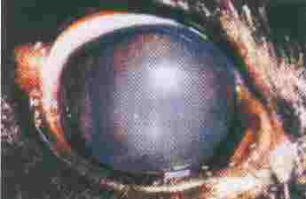 Redevet olho com catarata