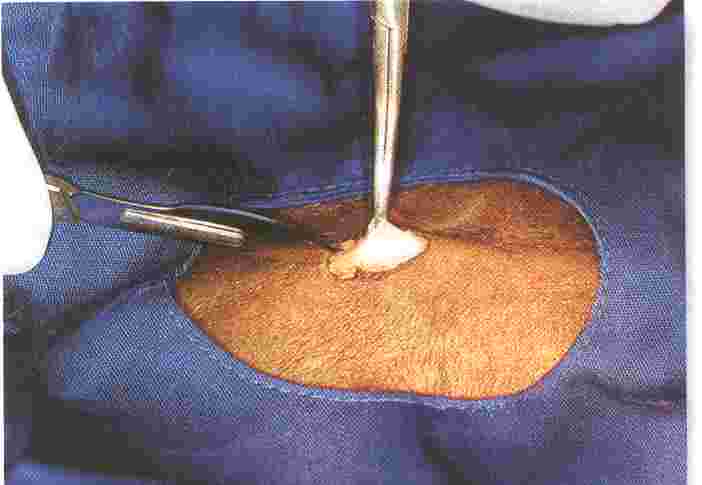 Redevet ovariosalpingo1