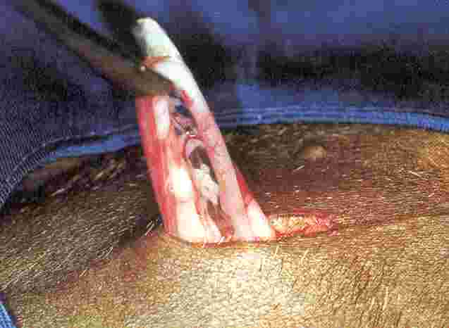 Redevet ovariosalpingo3