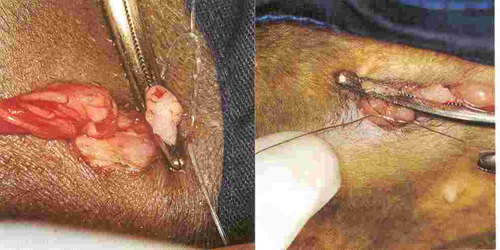 Redevet ovariosalpingo5