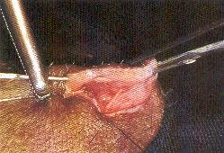 Redevet ovariosalpingo9