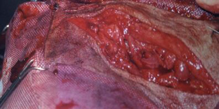 Redevet Hernia ingual10