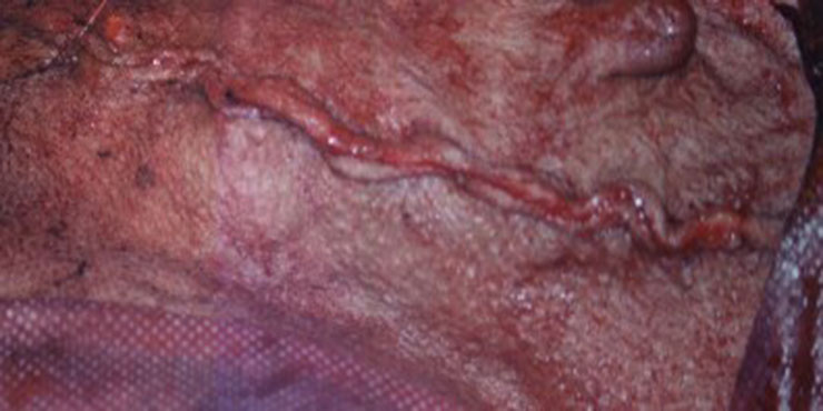 Redevet Hernia ingual11