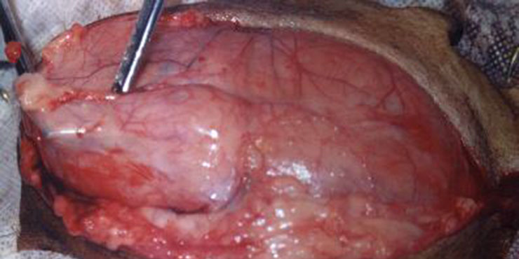 Redevet Hernia ingual3