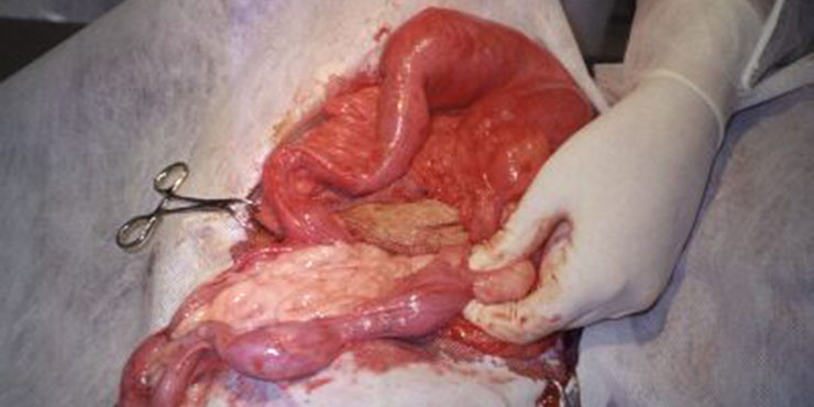 Redevet Hernia ingual5