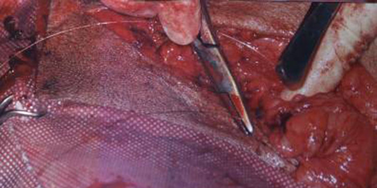 Redevet Hernia ingual8