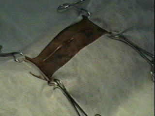 Redevet-Pneumotórax1