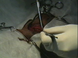 Redevet-Pneumotórax2