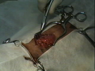 Redevet-Pneumotórax4