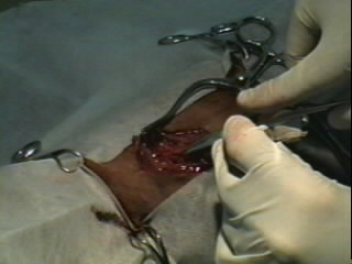 Redevet-Pneumotórax5