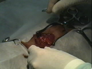 Redevet-Pneumotórax6