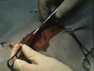 Redevet-Pneumotórax9