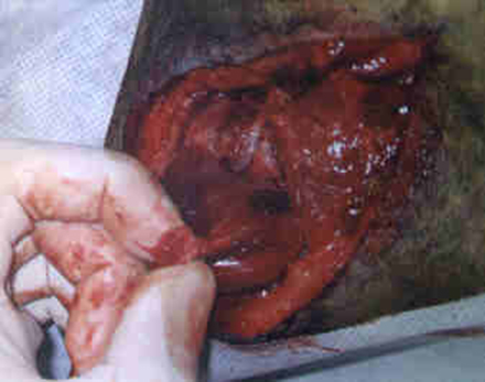 Redevet cirurgia caoxal1