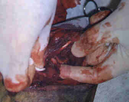 Redevet cirurgia caoxal2