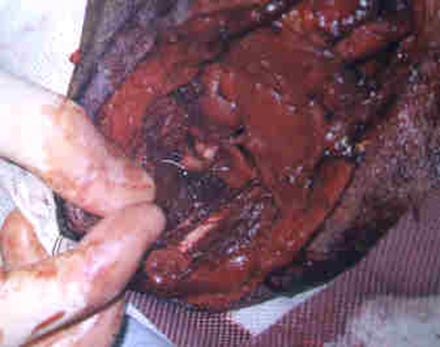 Redevet cirurgia caoxal3