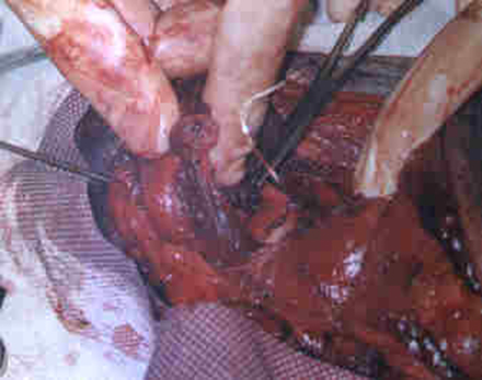 Redevet cirurgia caoxal4