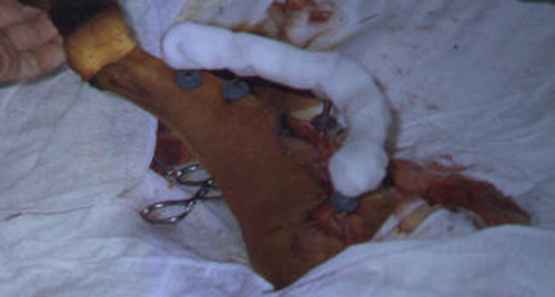 Redevet cirurgia fixação femur3