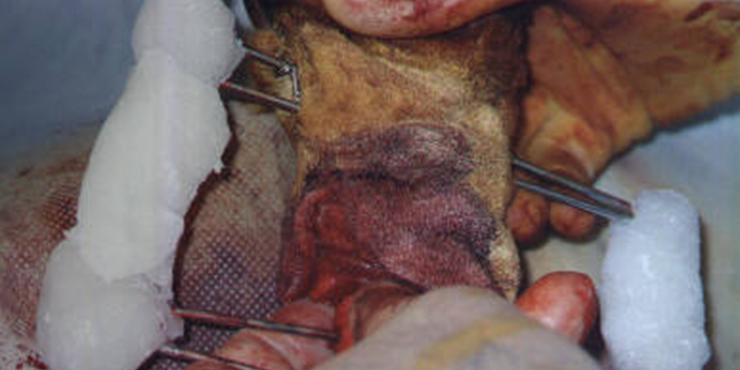 Redevet cirurgia radio ulna externo10