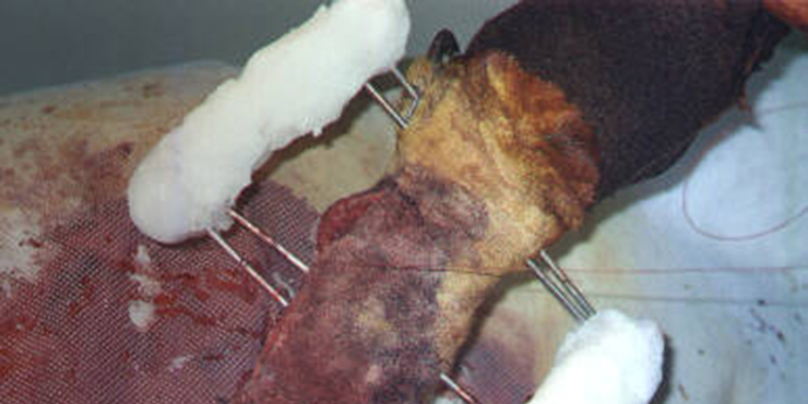 Redevet cirurgia radio ulna externo6