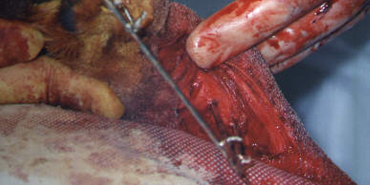 Redevet cirurgia radio ulna externo9