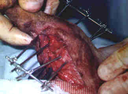 Redevet cirurgia tibia3