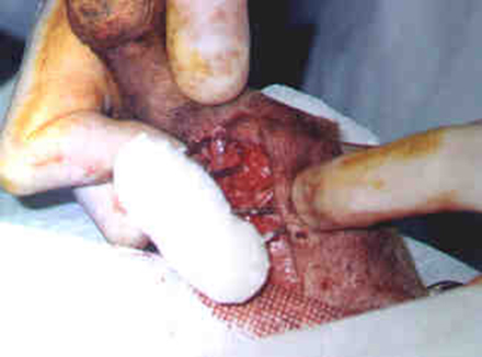 Redevet cirurgia tibia4