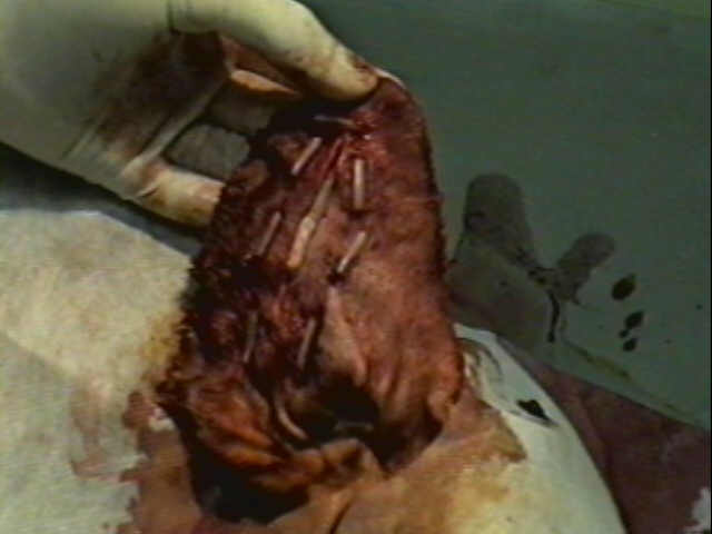 Redevet-otohematoma14