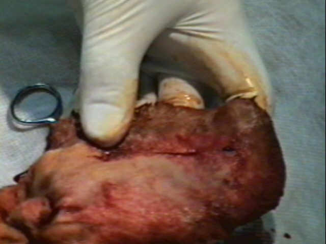 Redevet-otohematoma3