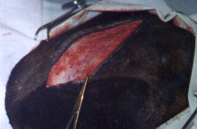 Redevet pino intromedular femur1