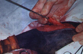 Redevet-pino-intromedular-femur3