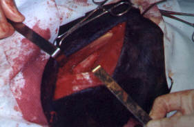 Redevet-pino-intromedular-femur6