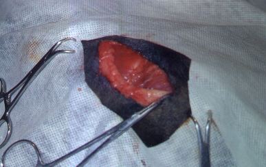 Redevet-resseccao-cabeca-femur1