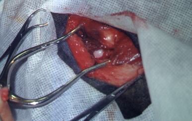 Redevet-resseccao-cabeca-femur2