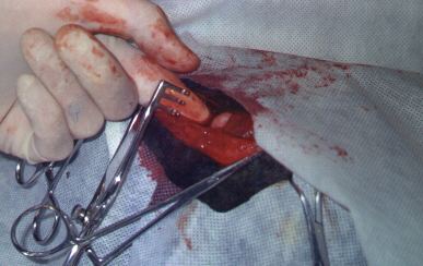 Redevet-resseccao-cabeca-femur4