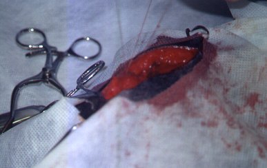 Redevet-resseccao-cabeca-femur6